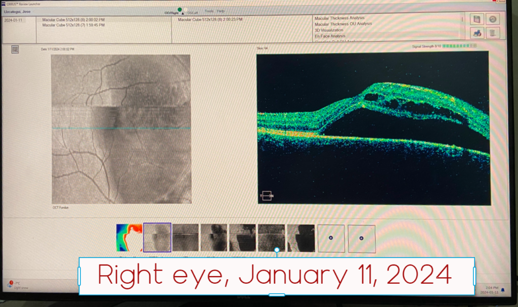 Right eye csr, jan 2024
