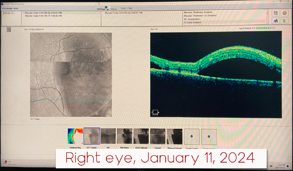 Right eye csr, jan 2024