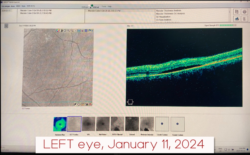 left eye csr, jan 2024